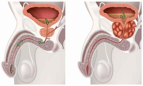 próstata sana e inflamada con prostatitis