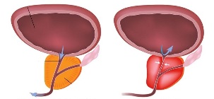 la prostatitis en los hombres