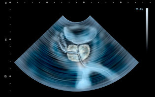 Síntomas de la prostatitis en la ecografía