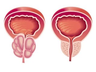 Como se ve la prostatitis