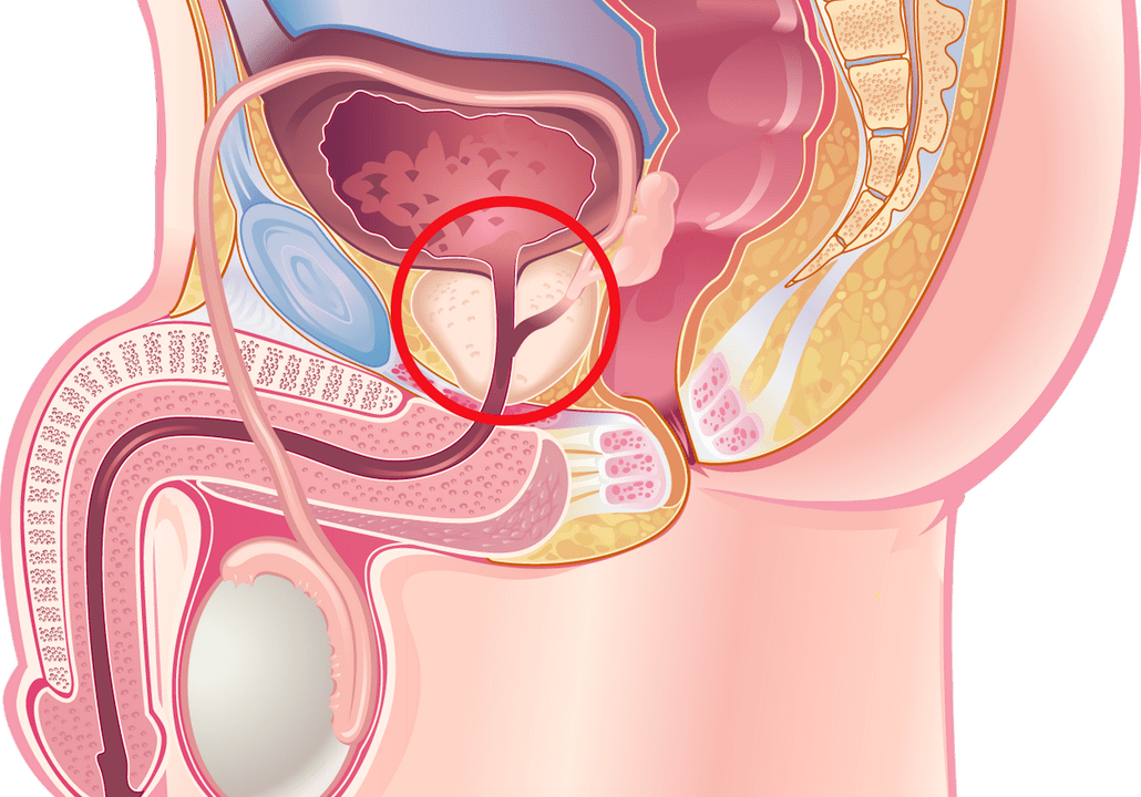 síntomas y signos de la prostatitis