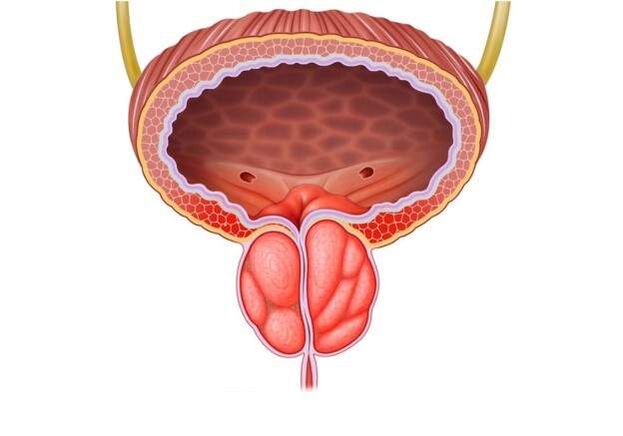 tratamiento de la prostatitis en hombres